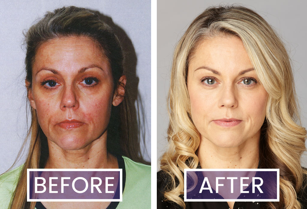 Head shot photos of Facial Flex Trialist Denise Downes before and after using the device for 16 weeks
