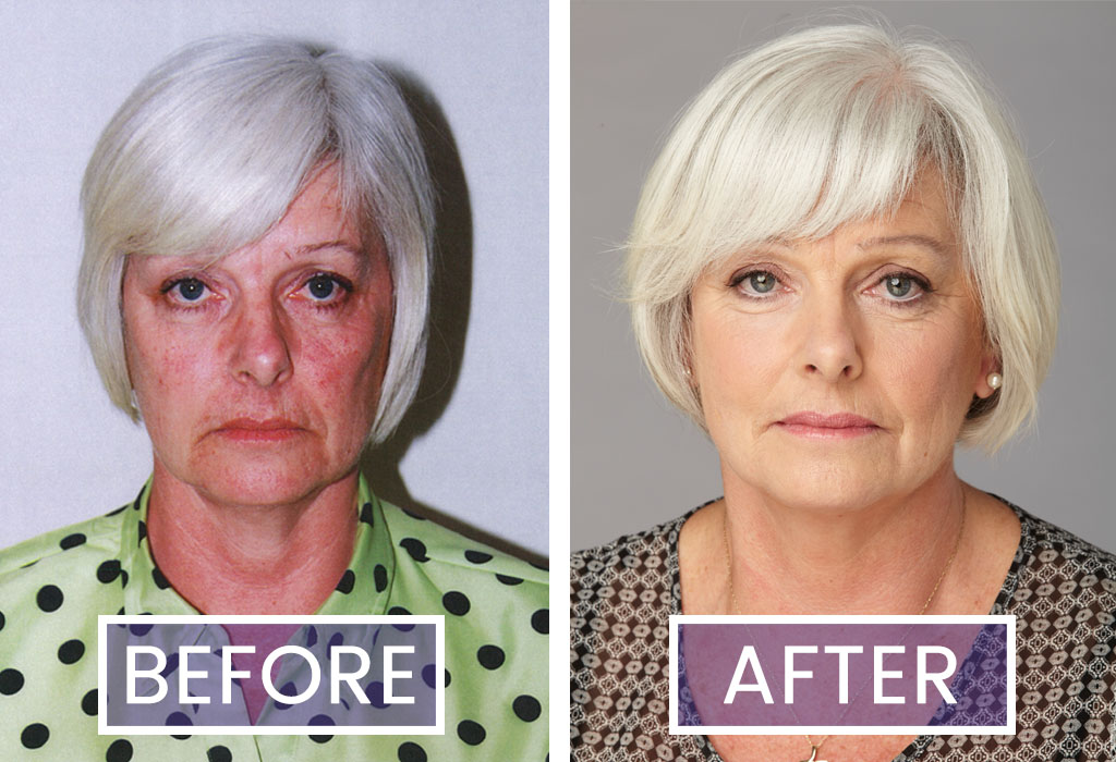 Before and after images of Facial-Flex trialist Jackie Allen