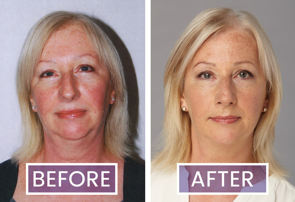 Head shot photos of Facial Flex Trialist Lynne Pounder before and after using the device for 16 weeks